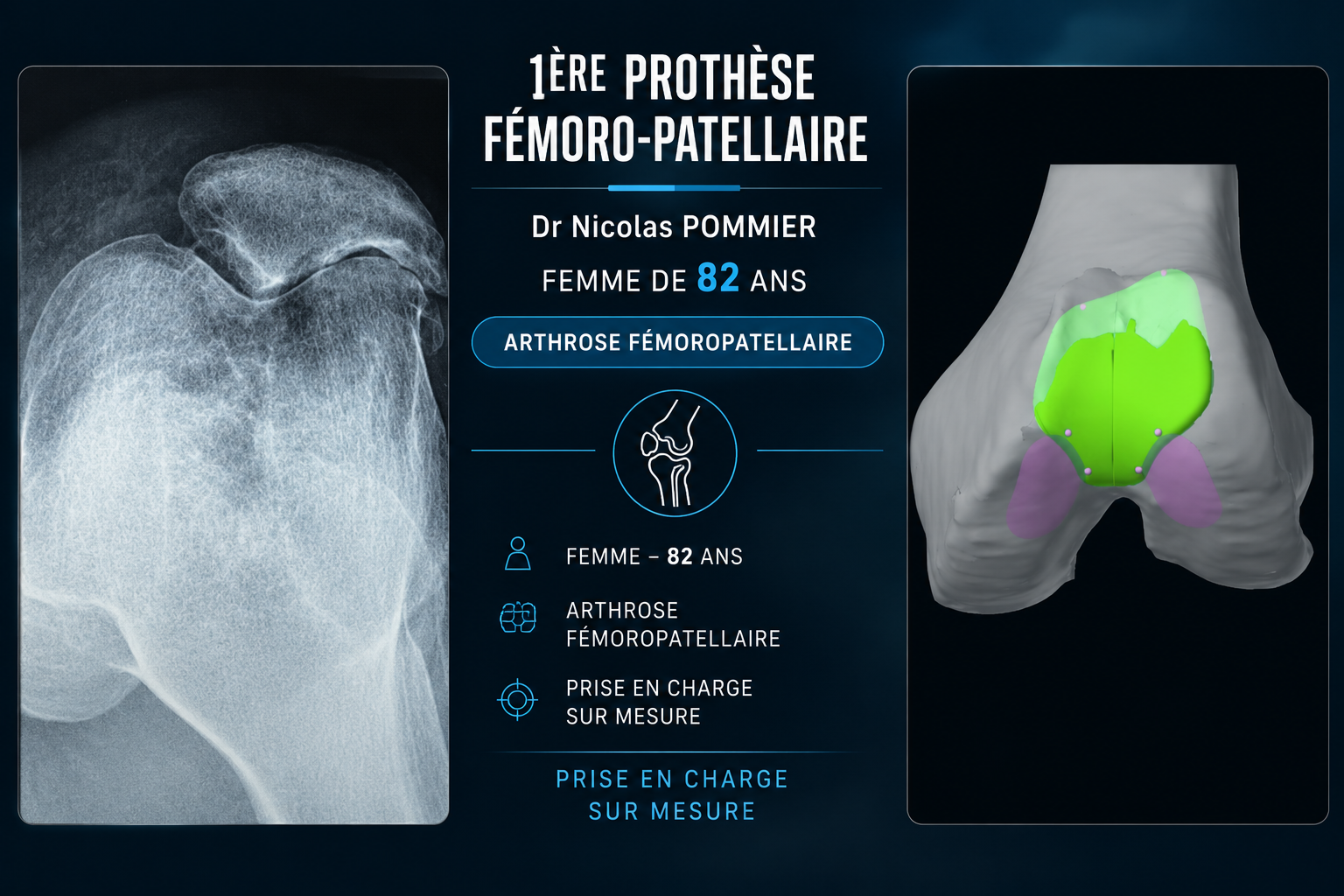 Cas clinique — première prothèse fémoro-patellaire, arthrose fémoro-patellaire chez une patiente de 82 ans