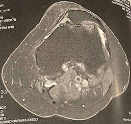 Cas clinique — première prothèse fémoro-patellaire, arthrose fémoro-patellaire chez une patiente de 82 ans