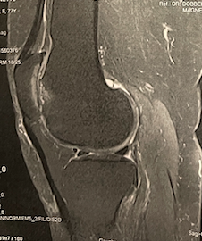 Cas clinique — première prothèse fémoro-patellaire, arthrose fémoro-patellaire chez une patiente de 82 ans