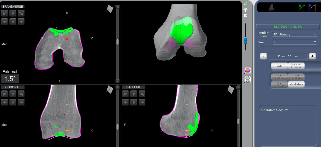 Cas clinique — première prothèse fémoro-patellaire, arthrose fémoro-patellaire chez une patiente de 82 ans