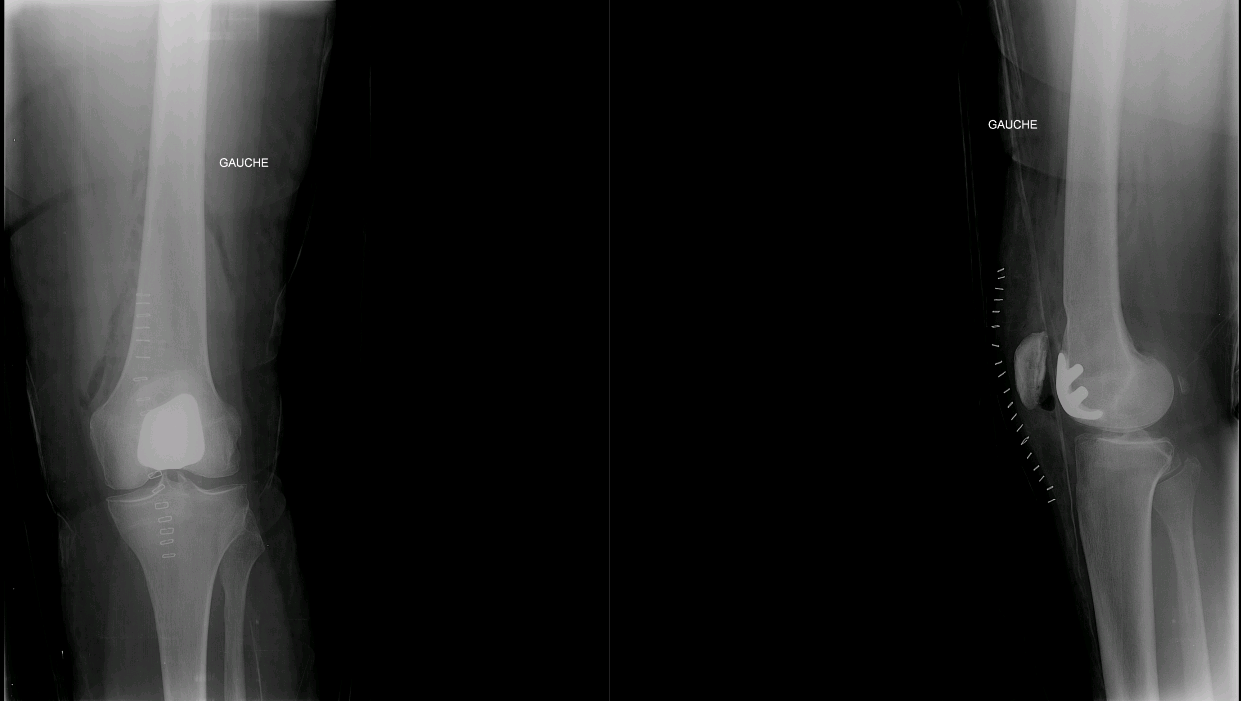 Cas clinique — première prothèse fémoro-patellaire, arthrose fémoro-patellaire chez une patiente de 82 ans