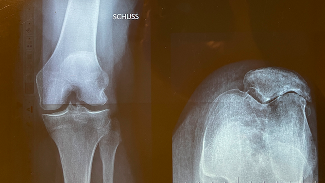 Cas clinique — première prothèse fémoro-patellaire, arthrose fémoro-patellaire chez une patiente de 82 ans