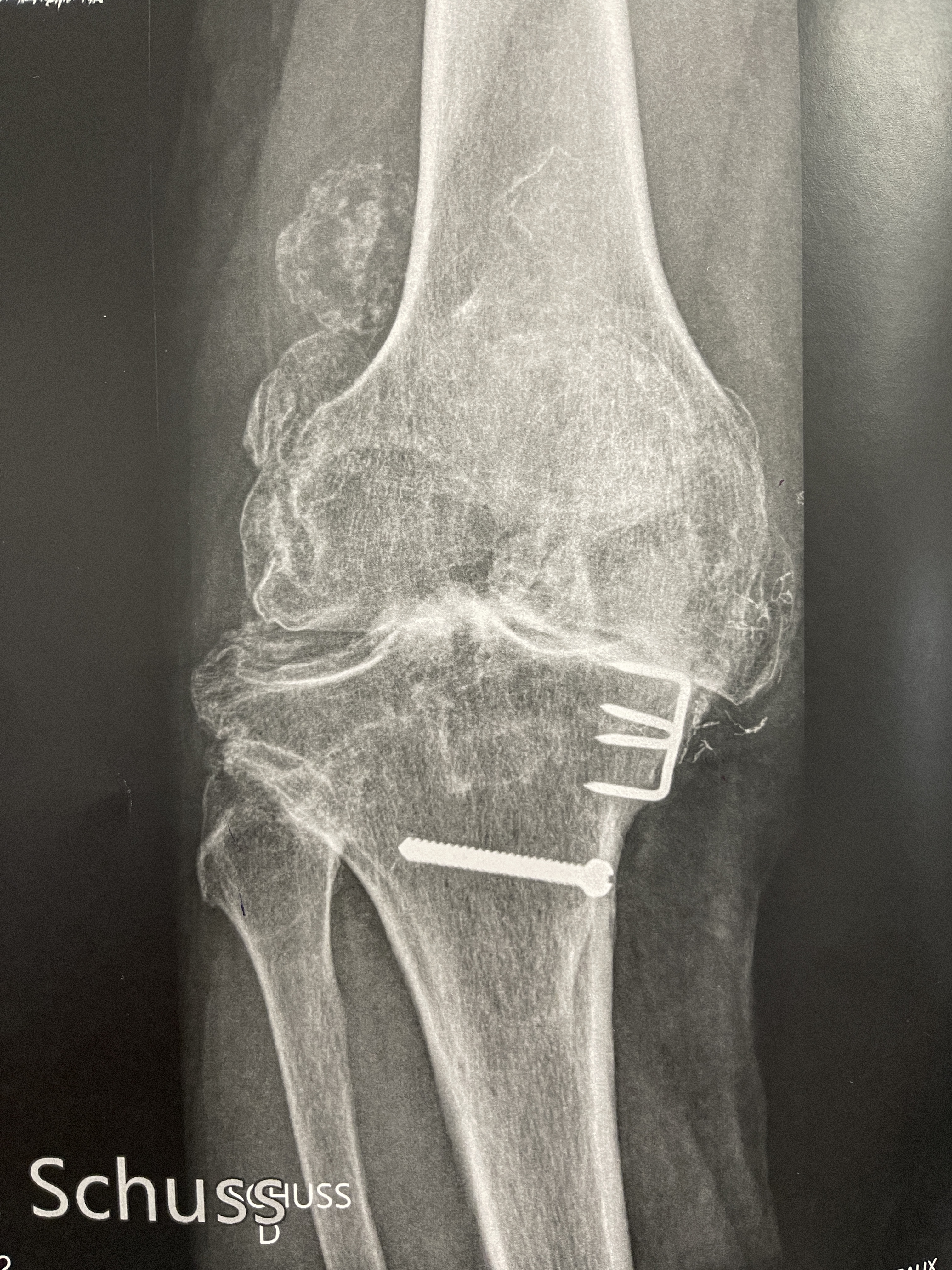 Cas clinique — ostéochondromatose diffuse et arthrose sévère du genou chez un patient de 75 ans