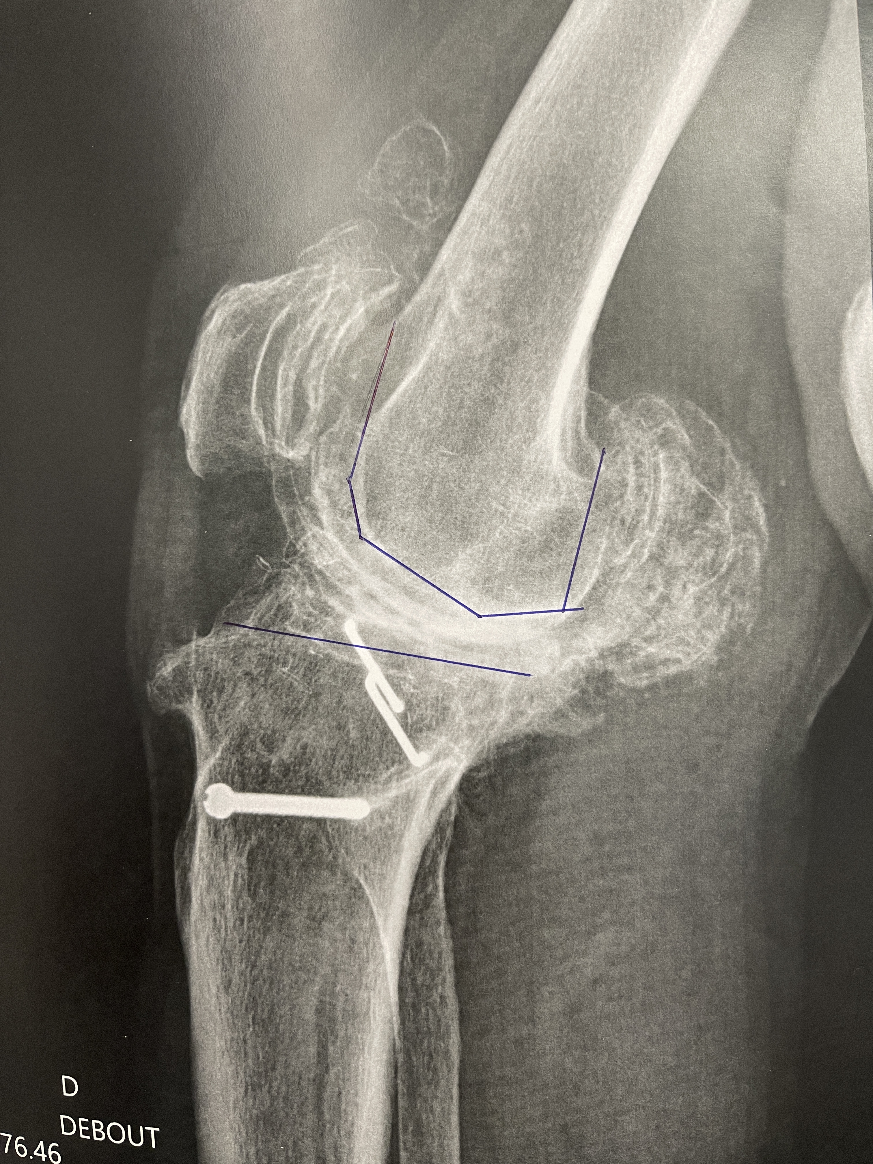 Cas clinique — ostéochondromatose diffuse et arthrose sévère du genou chez un patient de 75 ans