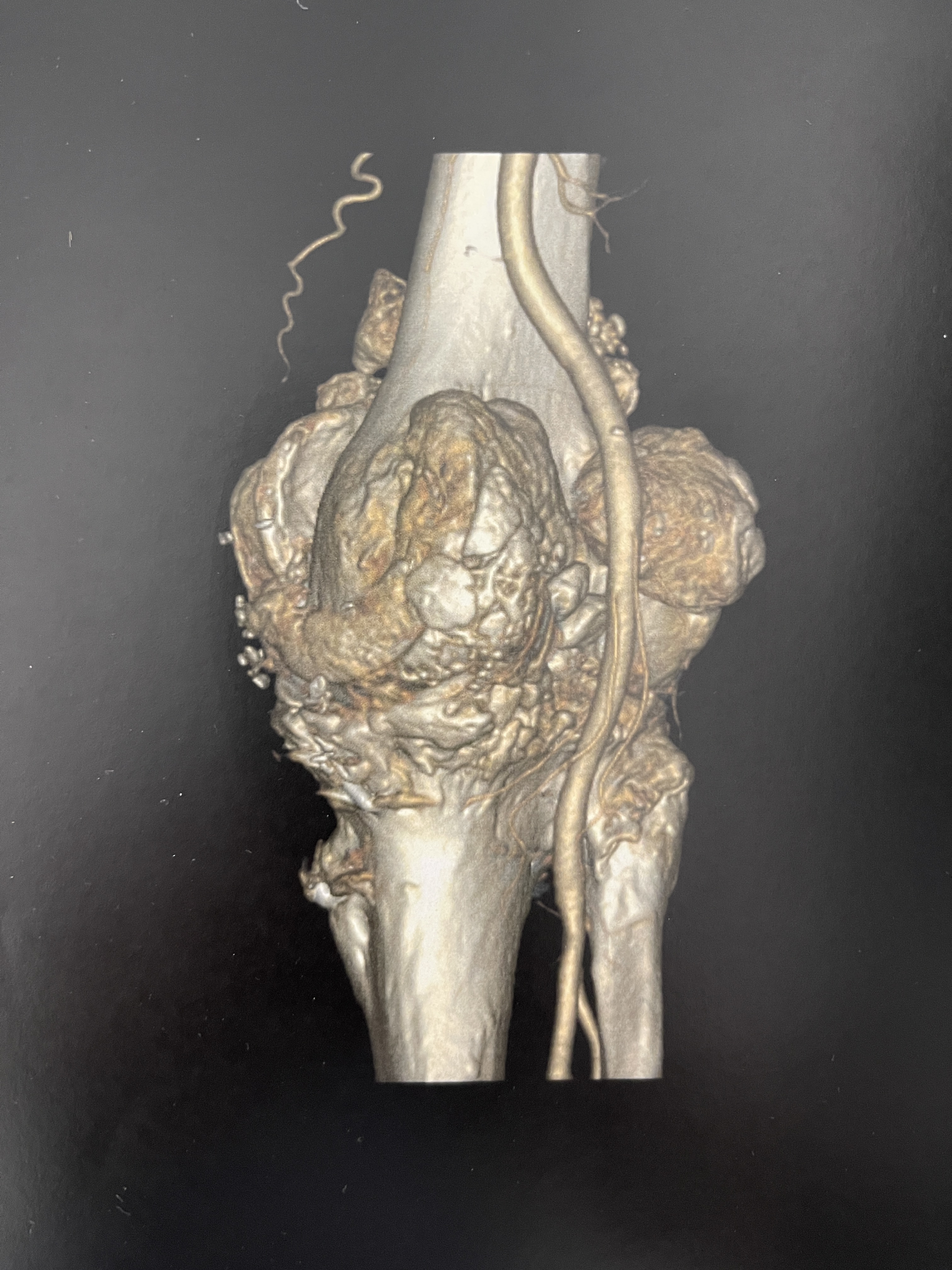 Cas clinique — ostéochondromatose diffuse et arthrose sévère du genou chez un patient de 75 ans