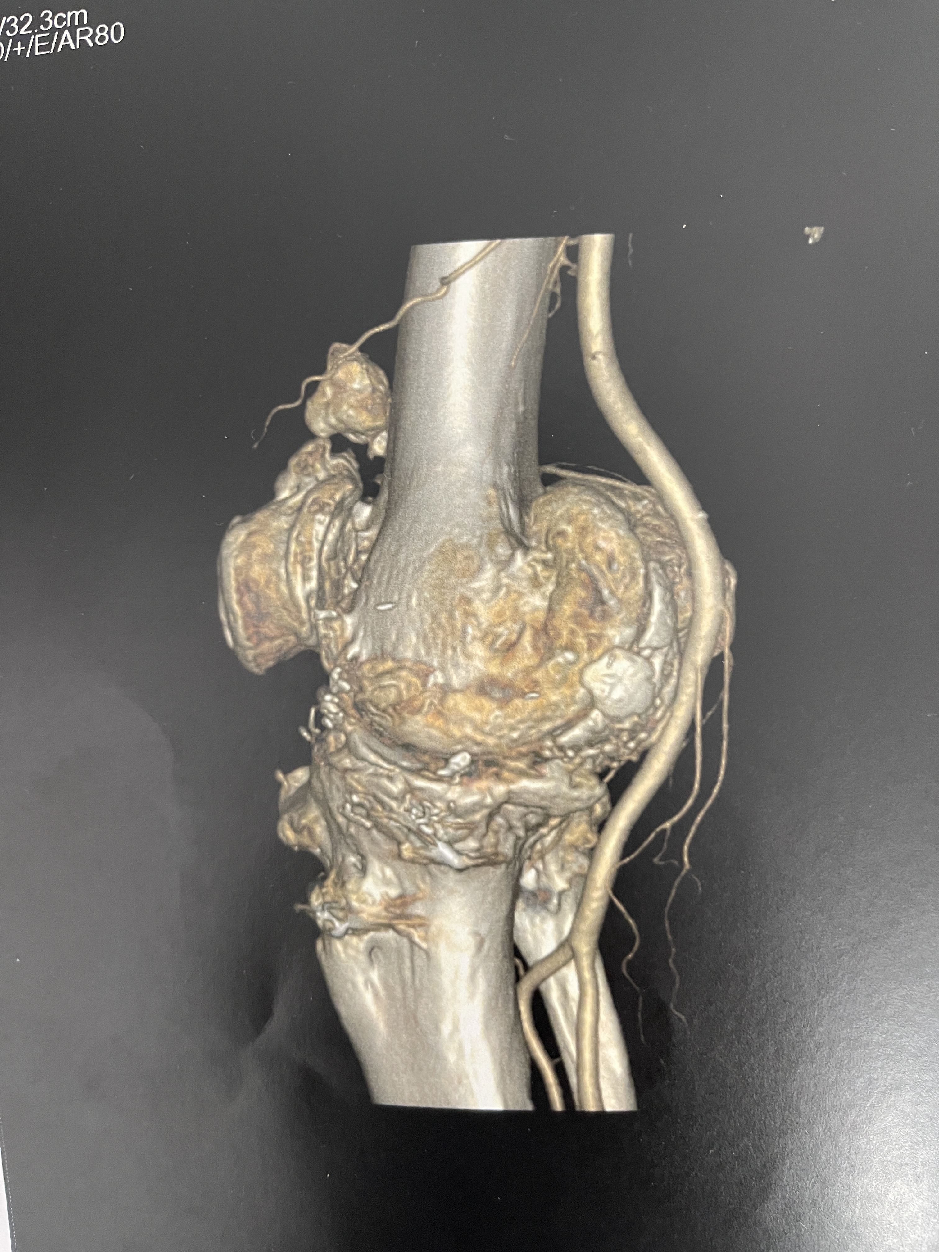 Cas clinique — ostéochondromatose diffuse et arthrose sévère du genou chez un patient de 75 ans