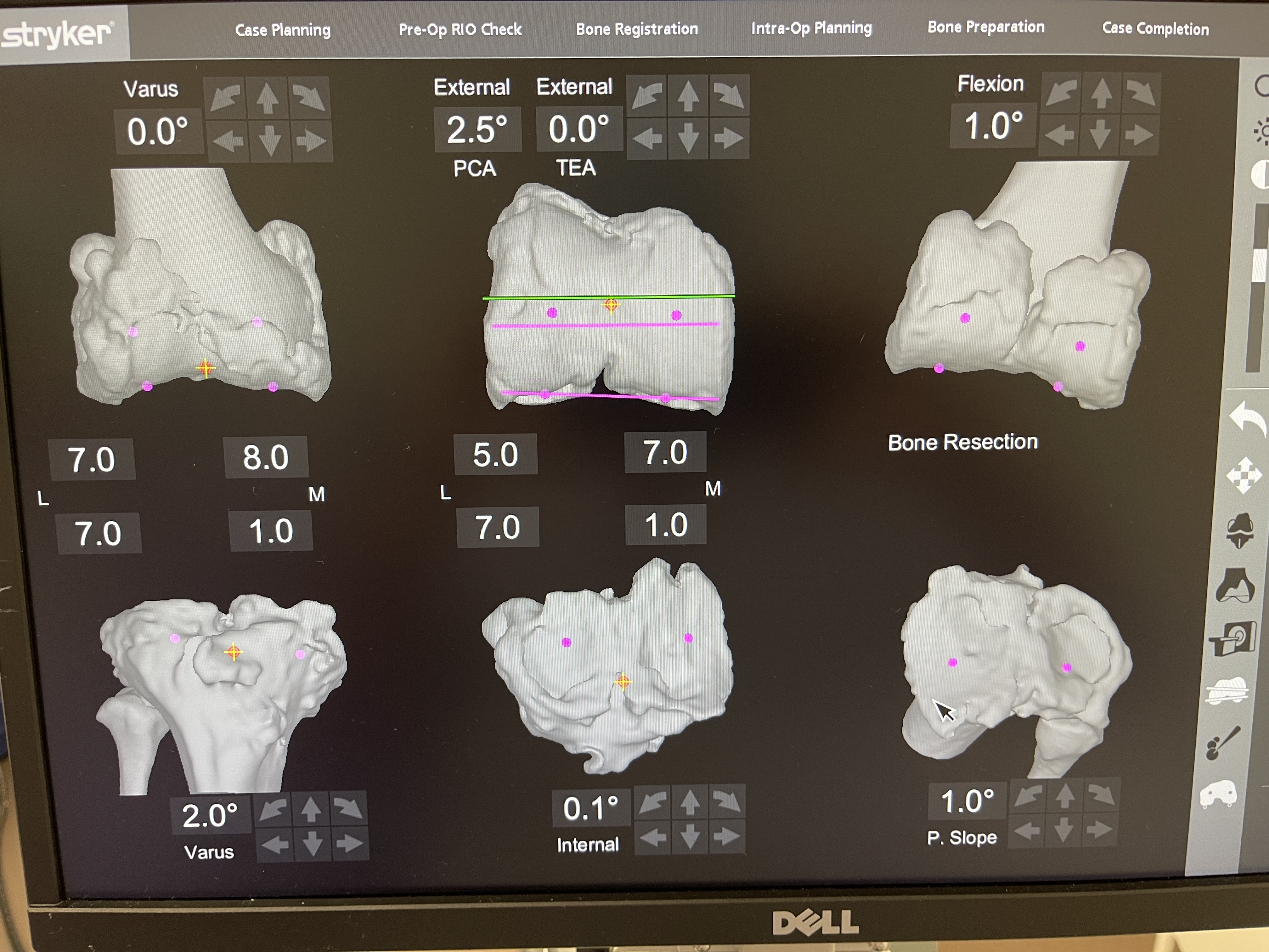 Cas clinique — ostéochondromatose diffuse et arthrose sévère du genou chez un patient de 75 ans