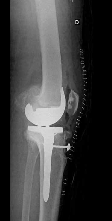 Cas clinique — ostéochondromatose diffuse et arthrose sévère du genou chez un patient de 75 ans