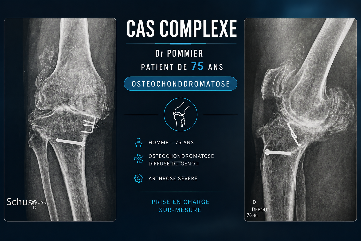 Cas clinique — ostéochondromatose diffuse et arthrose sévère du genou chez un patient de 75 ans