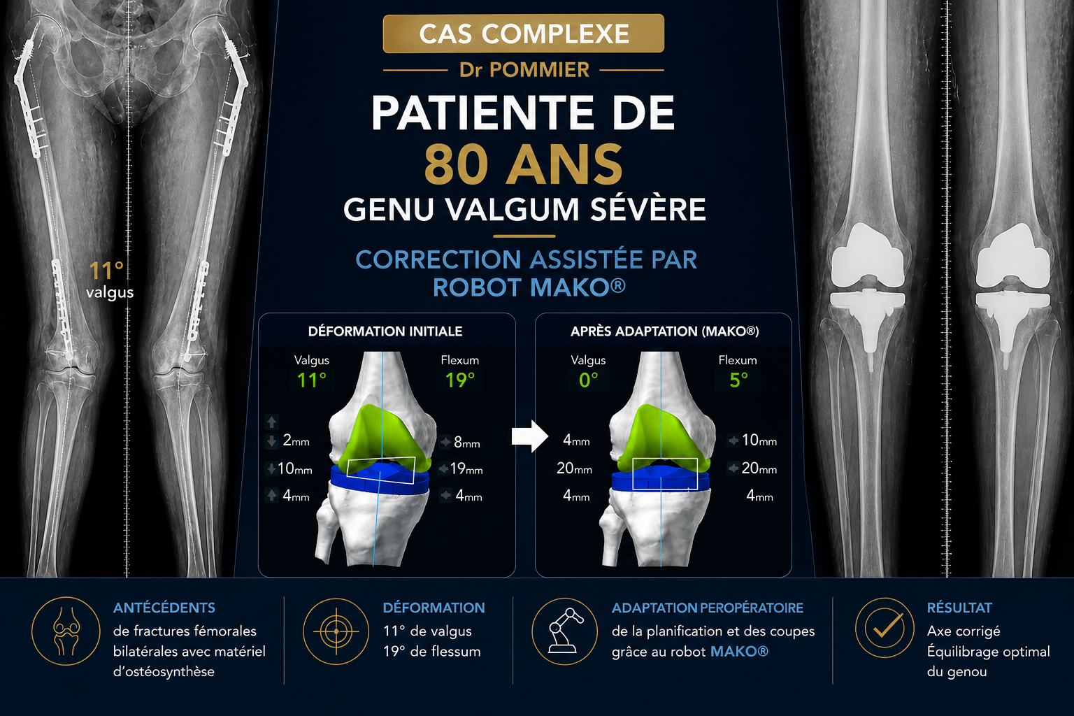 Cas complexe — patiente de 80 ans, genu valgum 11°, correction assistée par robot MAKO® à Bordeaux
