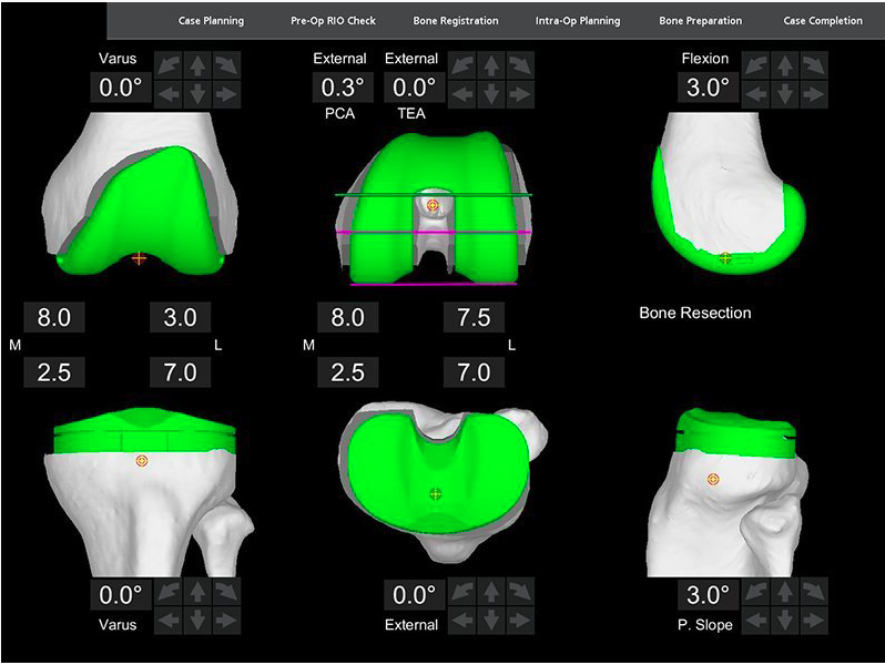 Planification 3D de prothèse de genou sur la console MAKO® SmartRobotics