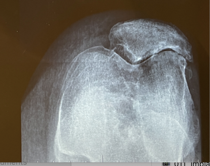 Arthrose fémoro-patellaire du genou