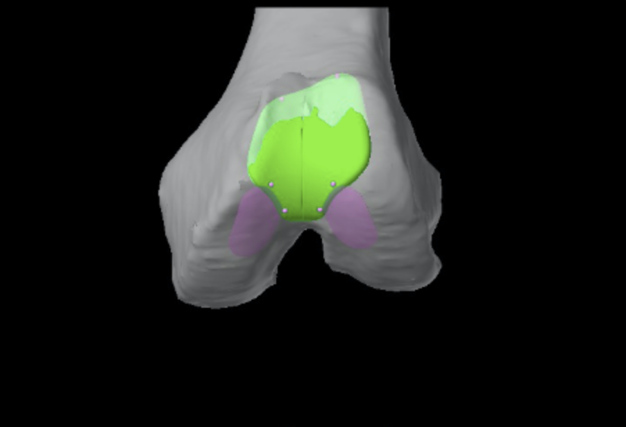 Planification MAKO® d’une prothèse fémoro-patellaire