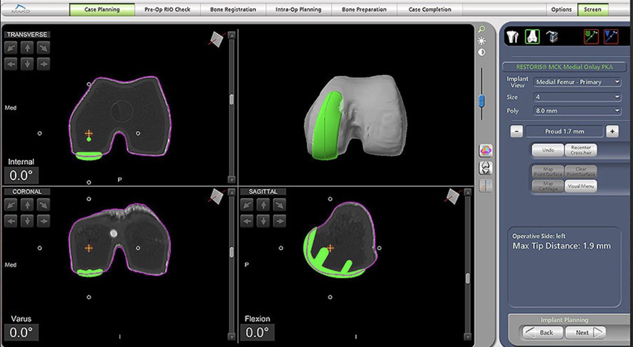 Planification 3D d’une prothèse unicompartimentale sur la console MAKO®