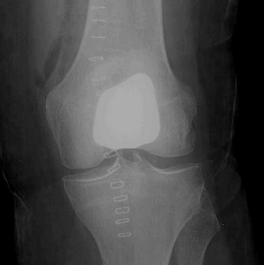 Radiographie de face après prothèse fémoro-patellaire