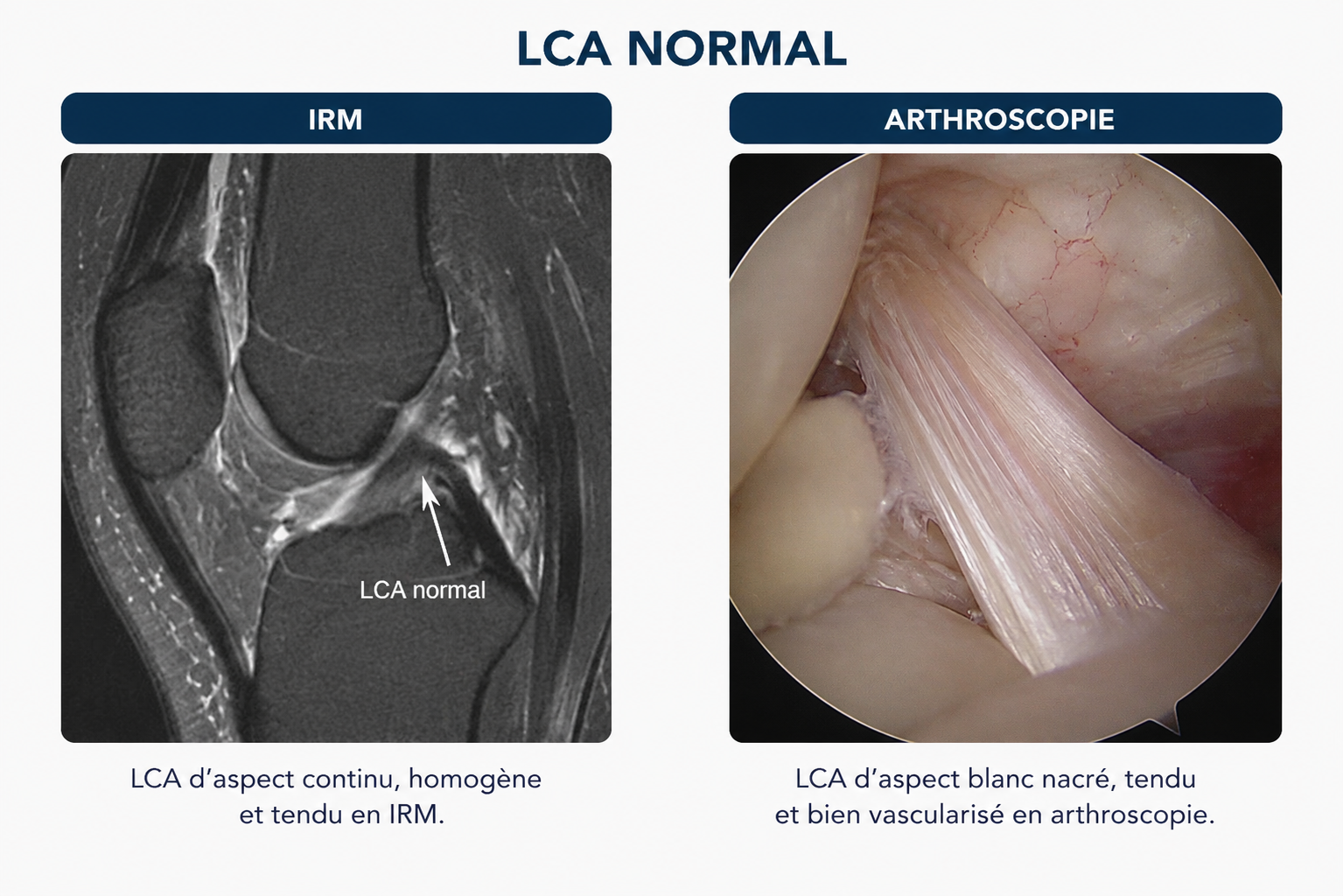ligament croisé antérieur LCA du genou anatomie